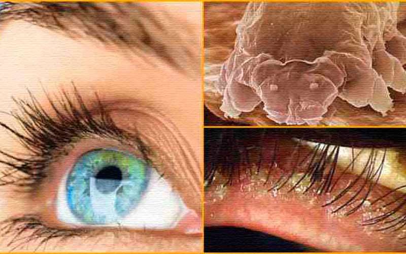 Глазной клещ: симптомы, лечение и фото