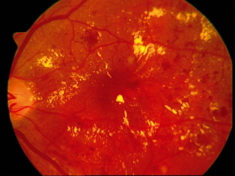 Диабетическая ретинопатия – лечение, операция на глазах при сахарном диабете