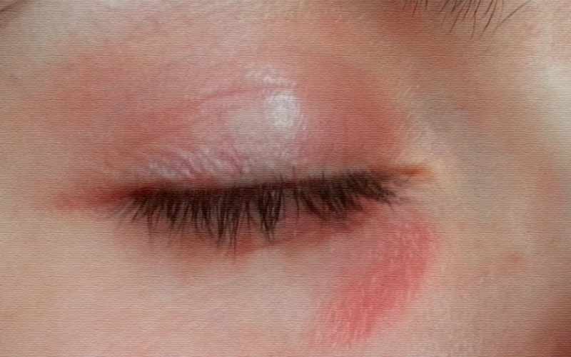 Шелушится и краснее кожа вокруг глаз: опасно ли это, и как с этим бороться?