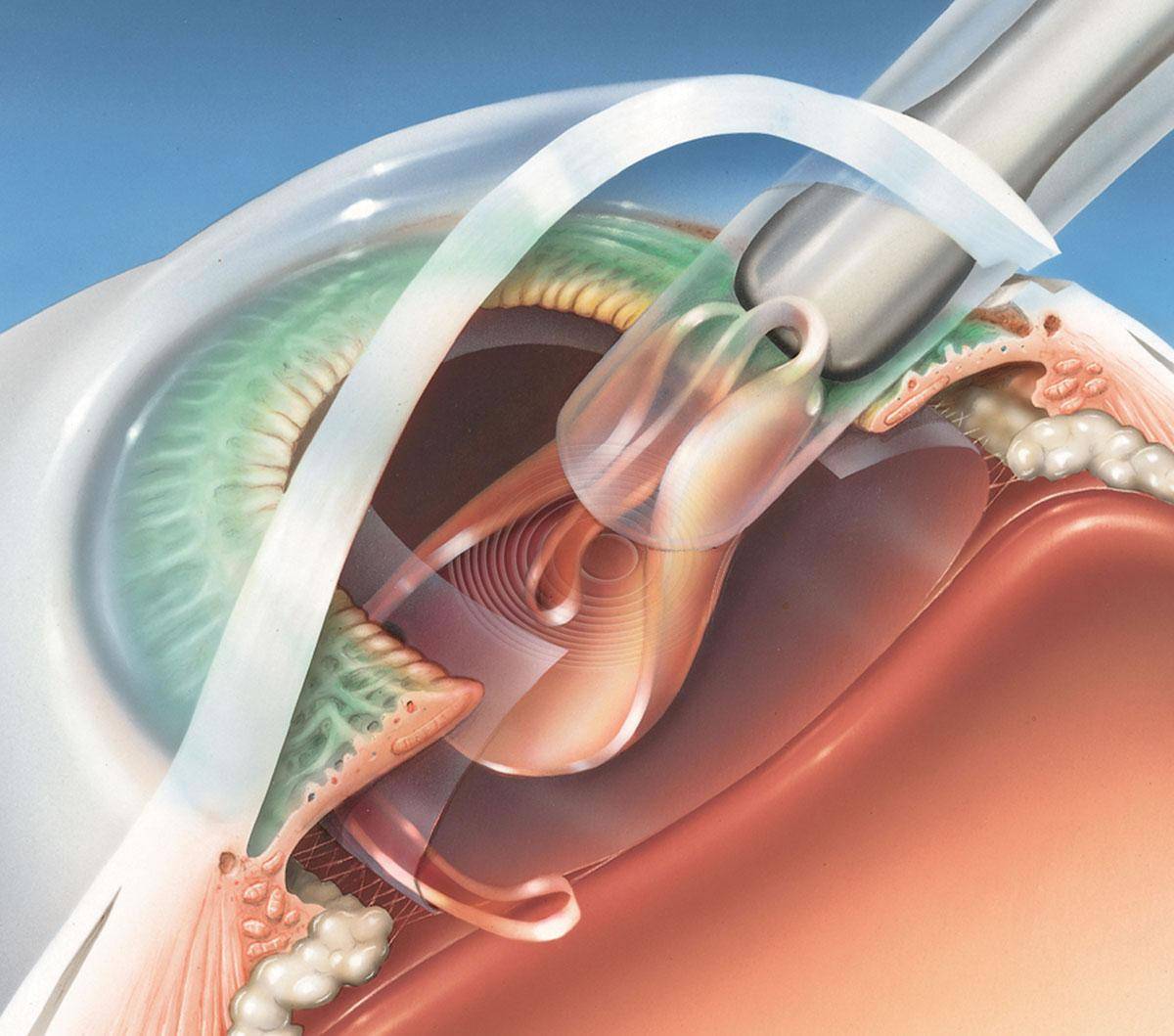 Экстракапсулярная экстракция катаракты без имплантации иол