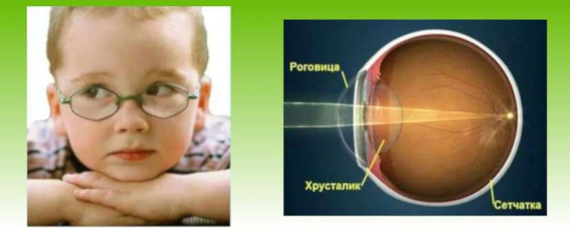 Популярное и эффективное лечение миопии у детей в статье детского офтальмолога