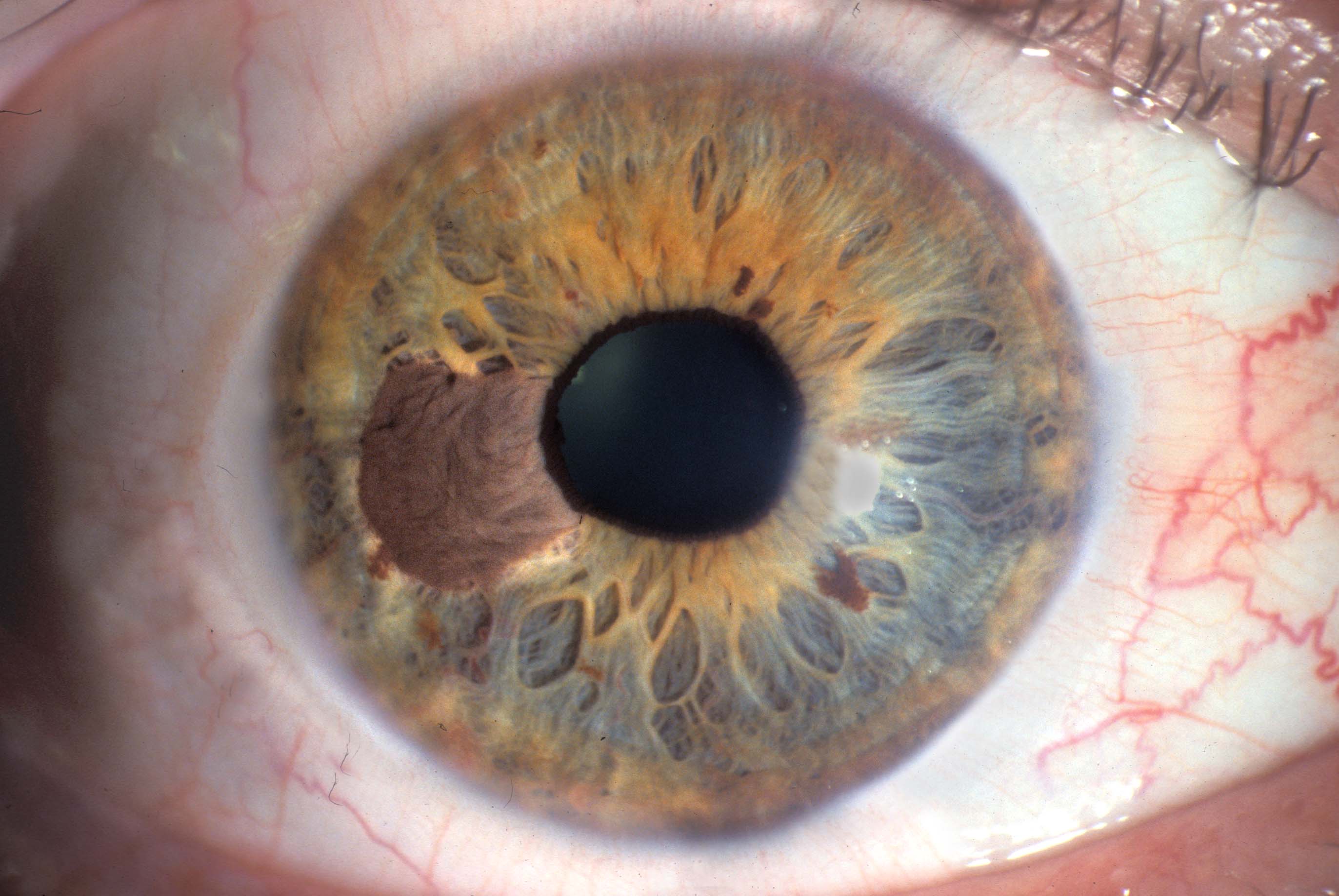 Эпиретинальный фиброз сетчатки глаза, лечение фиброза