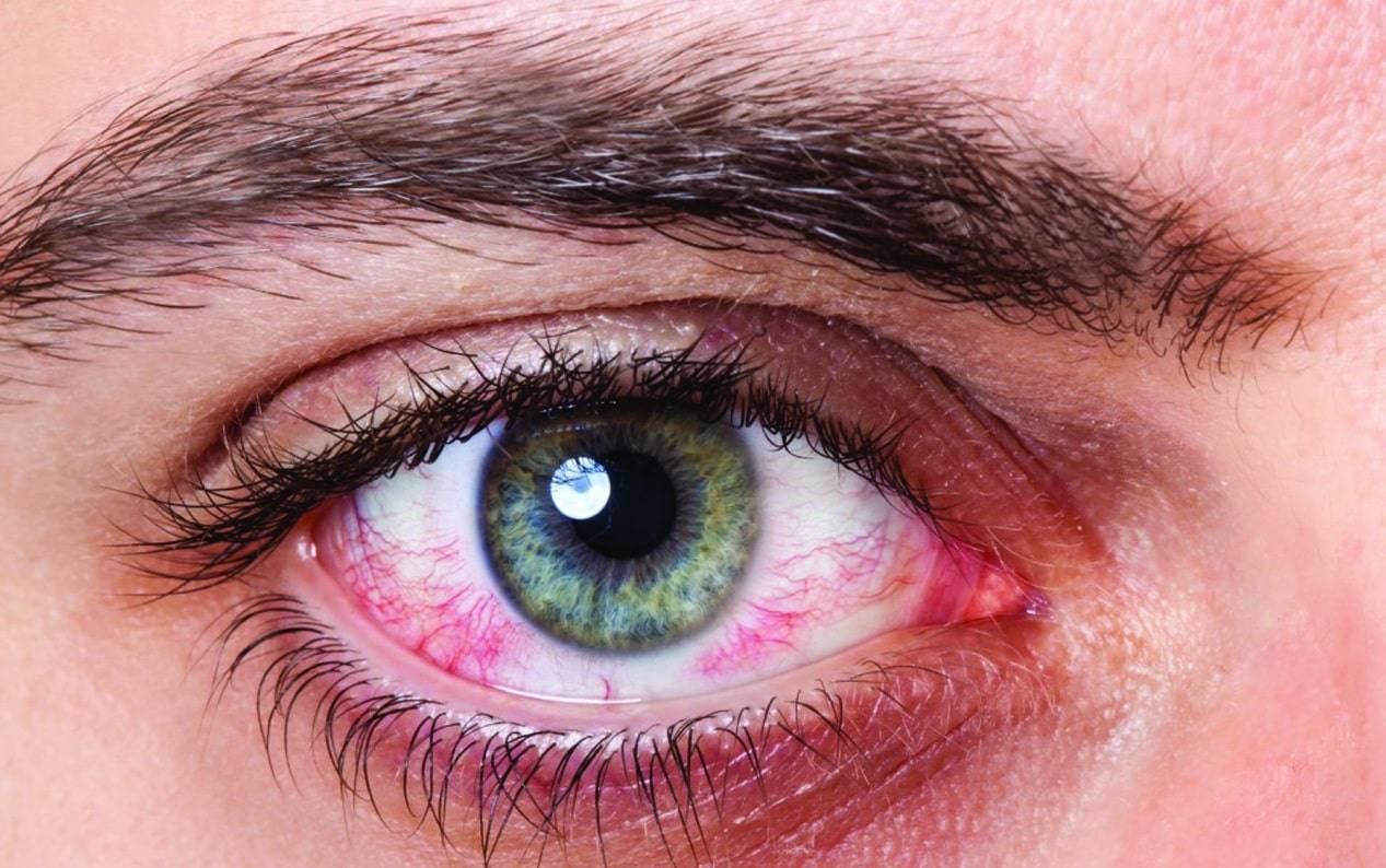 Синдром сухого глаза: симптомы, лечение, народные средства