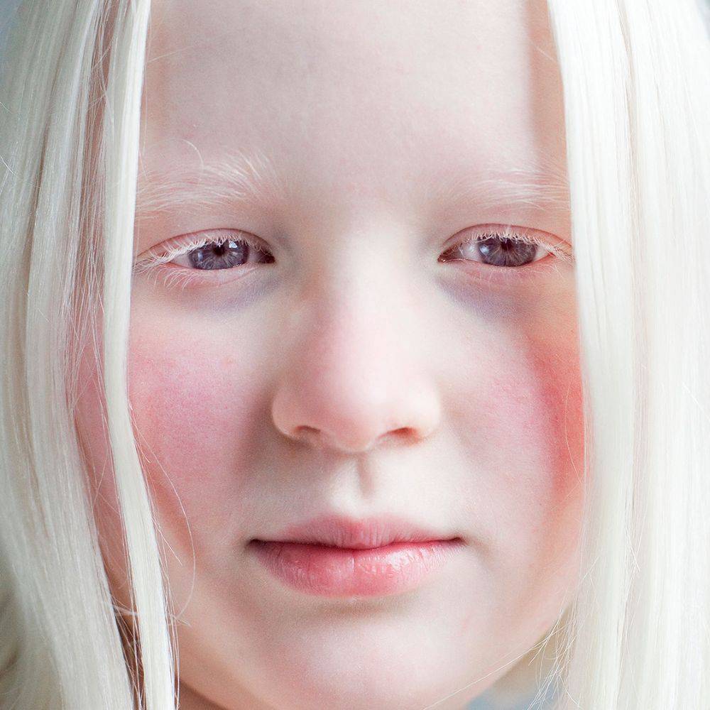 Альбинизм у человека - причины возникновения и как наследуется | люди - альбиносы