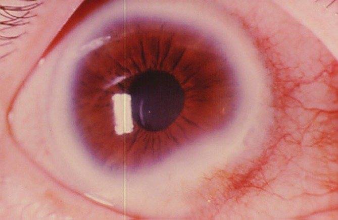 Ожог сетчатки глаза - причины, симптомы и лечение