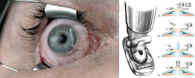 Операция фрк на глазах: послеоперационный период, осложнения