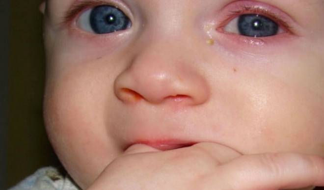 При простуде у ребенка гноятся глаза | глазной.ру