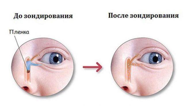 Дакриоцистит: симптомы и лечение - "здоровое око"