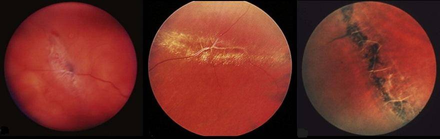 Истончение сетчатки глаза — причины и лечение