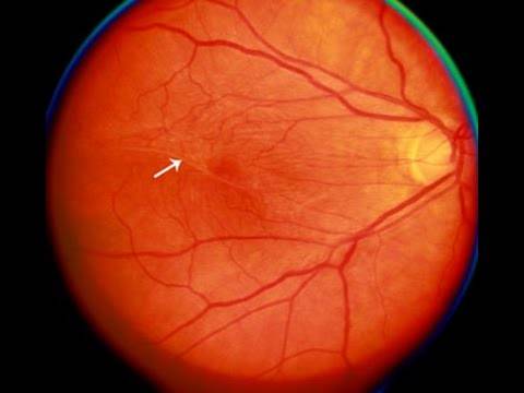 Что такое эпиретинальный фиброз глаза и как его лечить oculistic.ru
