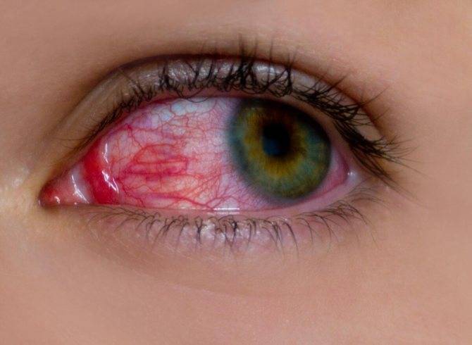 Глаза красные и слезятся: почему так происходит, что делать, если симптом появился внезапно, причины и лечение постоянного покраснения