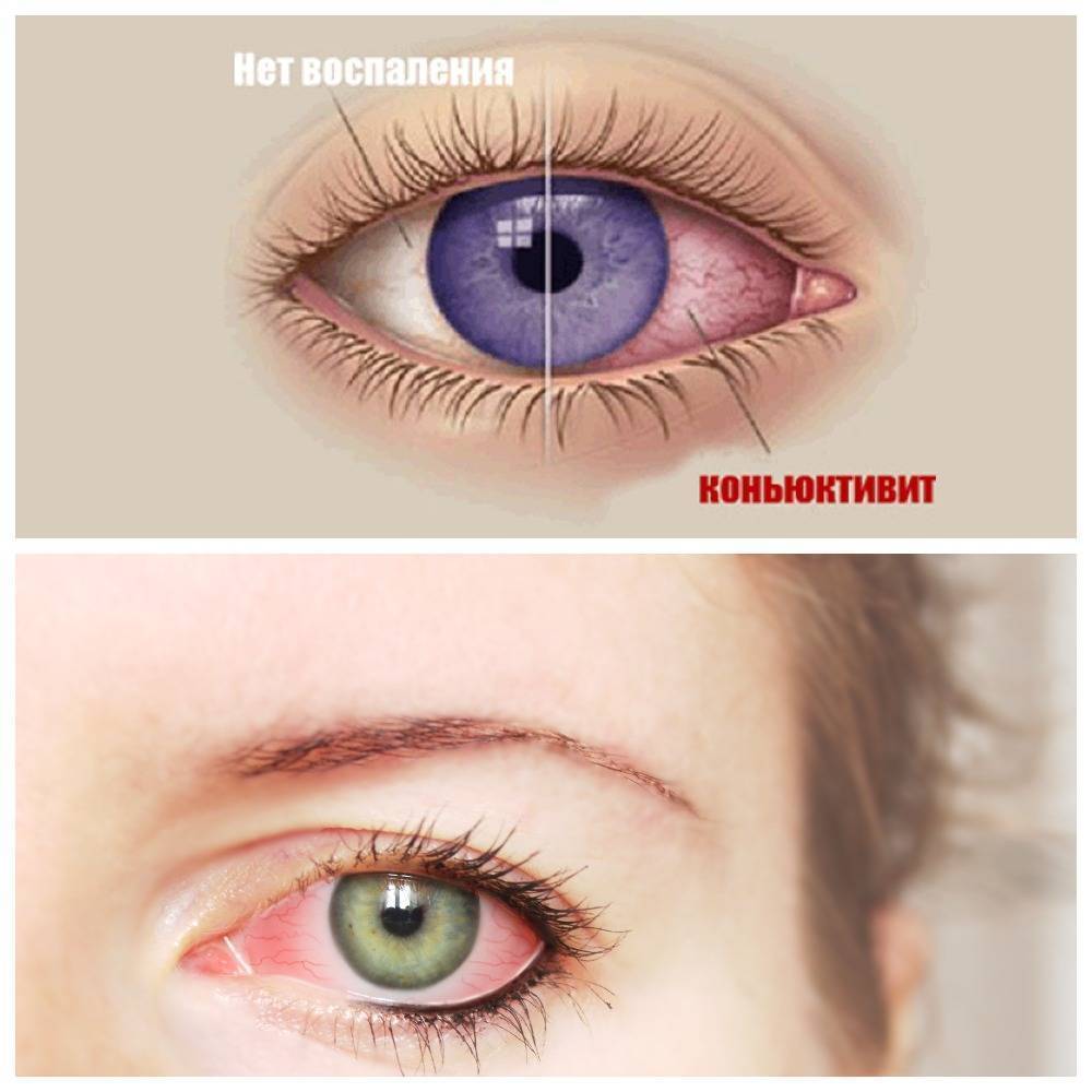 Конъюнктивит бактериальный - быстрое лечение глаз у взрослых