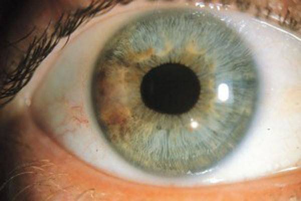 Иридодиагностика. как определить болезни по радужке глаз