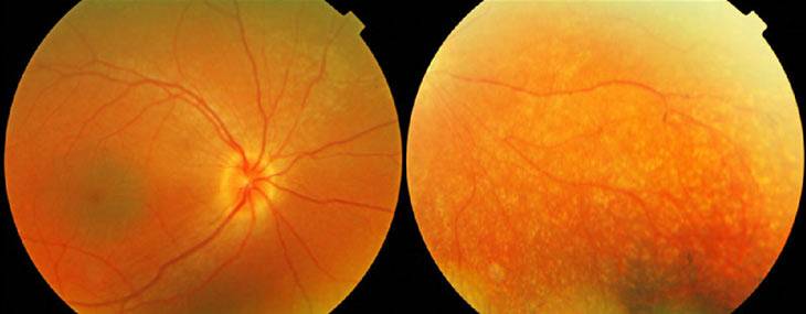 Что такое амавроз глаза: симптомы и лечение oculistic.ru
что такое амавроз глаза: симптомы и лечение