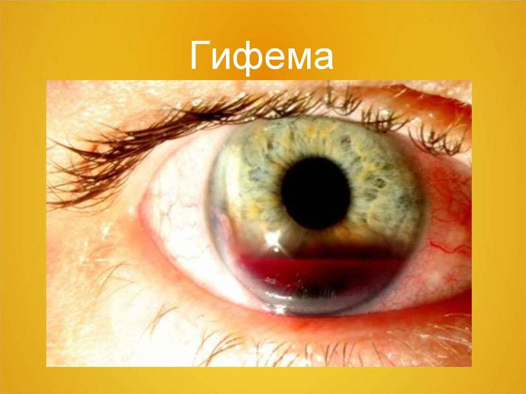 Гифема глаза: причины, симнтомы, лечение - "здоровое око"