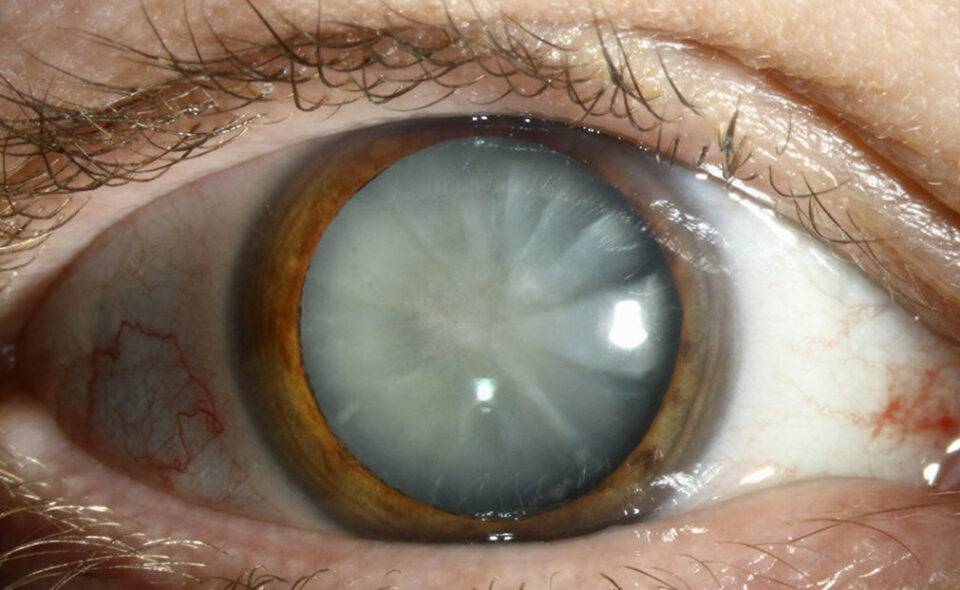 После операции катаракты: глаз не видит, двоится, отек роговицы, осложнения при удалении и замене хрусталика, причина близорукости