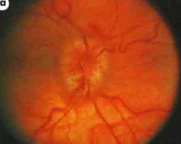 Неврит зрительного нерва: симптомы, лечение, причины, диагностика и осложнения