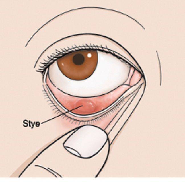 Чем лечить ячмень на глазу при беременности