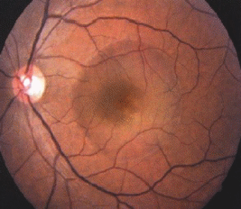 В чем опасность хориоретинита глаза, можно ли его вылечить и как?