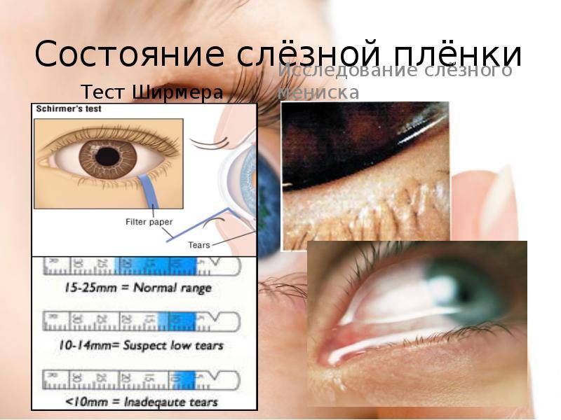 Тест ширмера - самый важный метод для проверки здоровья ваших глаз