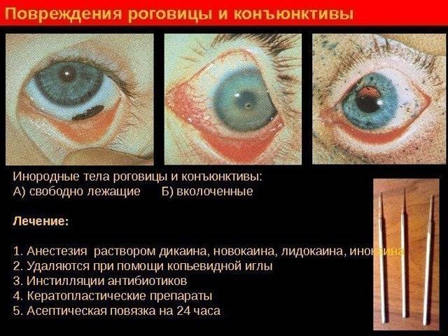 Повреждение роговицы глаза - лечение, последствия травмы, что делать
