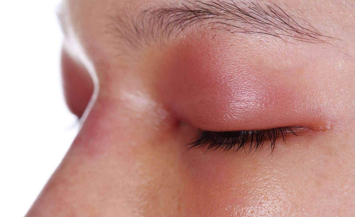 Аллергия на веках глаз — лечение и профилактика