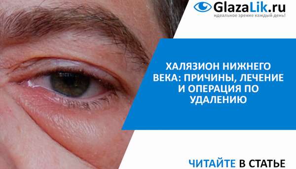 Халязион на глазу: лечение, причины, симптомы, удаление образования, терапия без операции, что это (фото), диагностика, профилатика