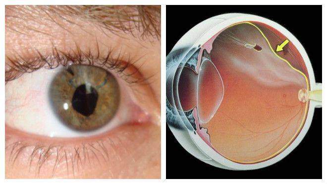 Операция при разрыве сетчатки глаза - показания, как проходит и как вести себя после вмешательства, делается ли по полису омс