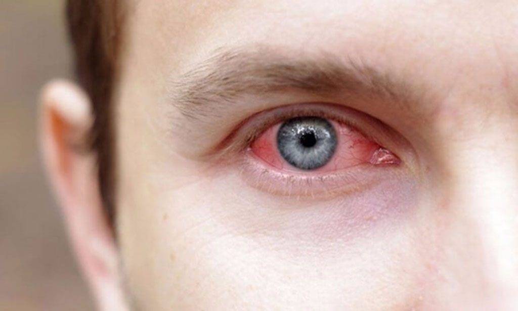 Глаза режет от компьютера: симптомы, причины и методы лечения - "здоровое око"
