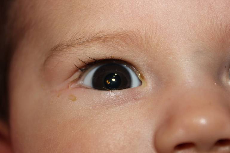 Глаза гноятся у ребенка - почему, и что с этим делать?