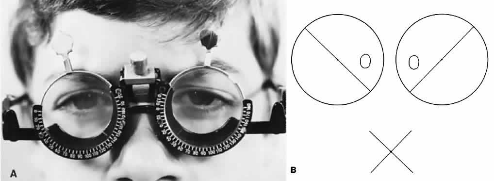 Тест амслера: сетка для глаз на зрение, решетка и таблица для проверки, как пользоваться, что это такое