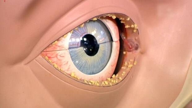 Травма глаза: классификация, первая помощь и лечение