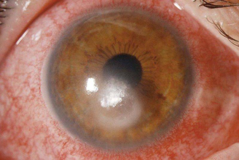 Кератит глаза: причины, симптомы и лечение воспаления роговицы, что это такое (фото)