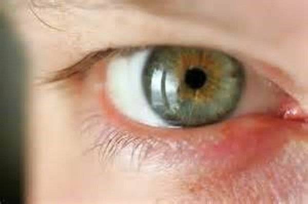 Куриная слепота (гемералопия) - что это, причины и лечение