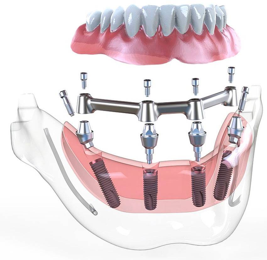 Рейтинг имплантов для зубов от премиального до бюджетного сегмента