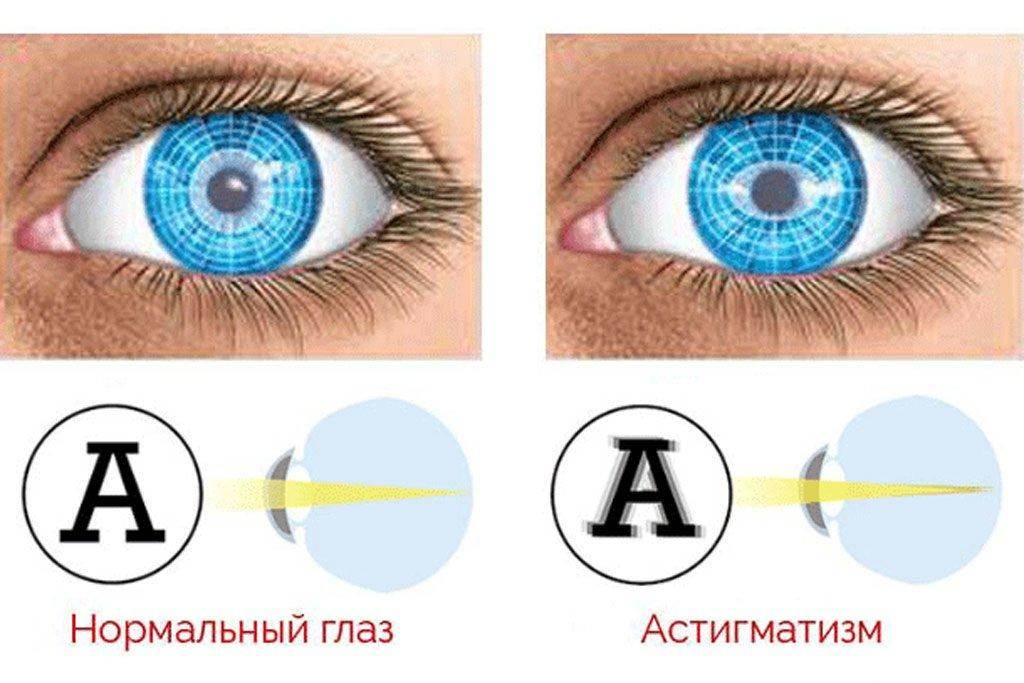 Лечение астигматизма глаз у взрослых: упражнения, капли
