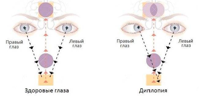 Двоится в глазах - причины: двоение при взгляде вдаль, двойное зрение лечение при шейном остеохондрозе, неврология, раздвоение диплопии