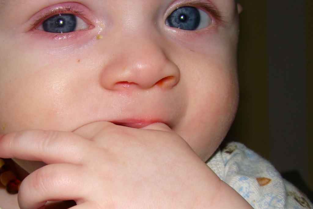 Конъюнктивит у новорожденных: как и чем лечить ребенка | мрикрнц.рф