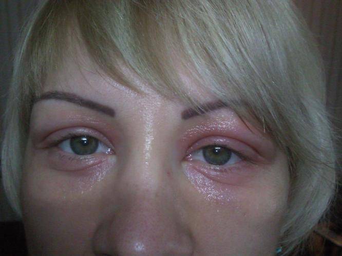 Как снять аллергический отек с глаз?