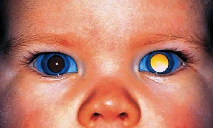 Пятно на белке глаза: причины, симптомы, лечение