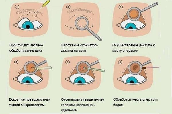 Методы лечения и удаления халязиона верхнего и нижнего века глаза