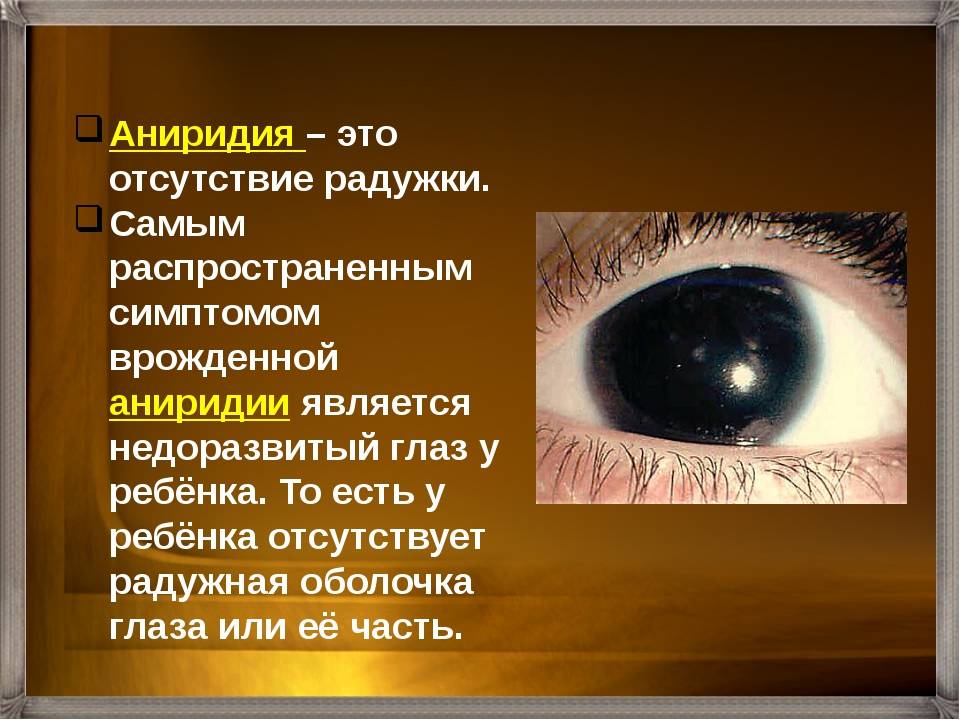Что такое аниридия глаза. диагностика, лечение и профилактика аниридии.