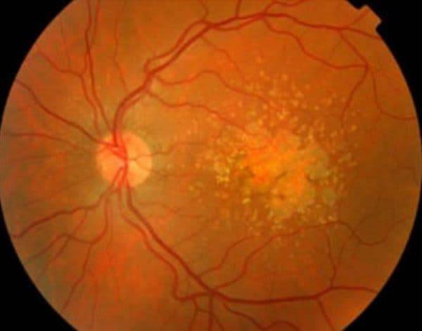 Пхрд глаза: что это такое, степени тяжести, критерии диагноза, лечение патологии обоих глаз