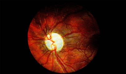 Ишемическая нейропатия зрительного нерва: лечение передней и задней форм
