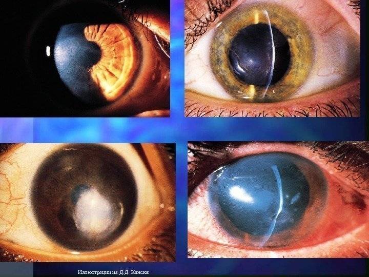 Энуклеация – суть и секреты операции по удалению глаза
