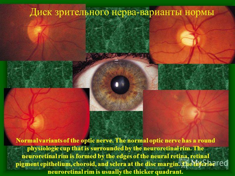 Застойный диск зрительного нерва: причины, симптомы и лечение заболевания