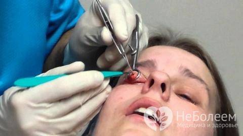 Как проходит операция по удалению халязиона на глазу