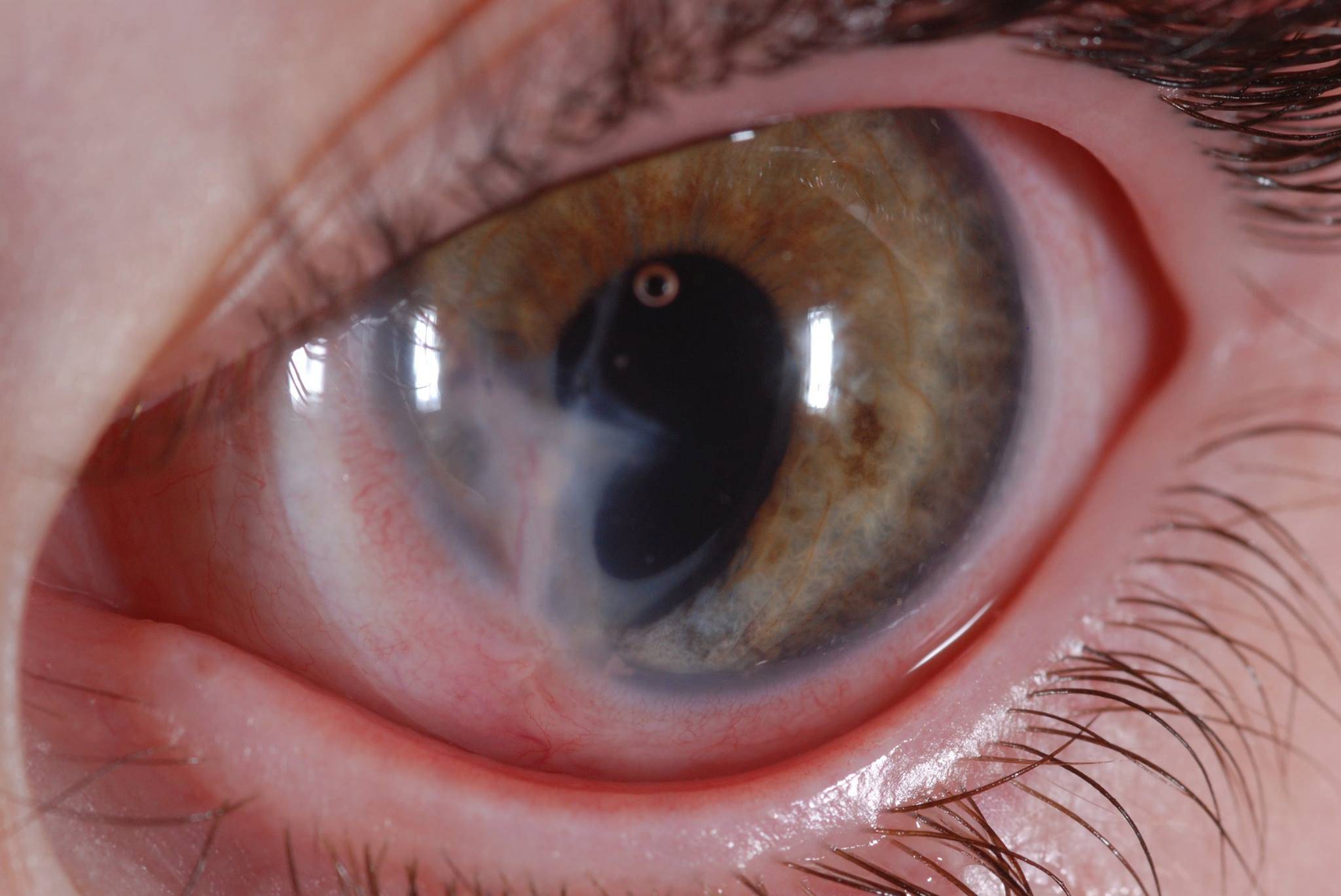 Травмы роговицы и слизистой глаза: симптомы, первая помощь, лечение