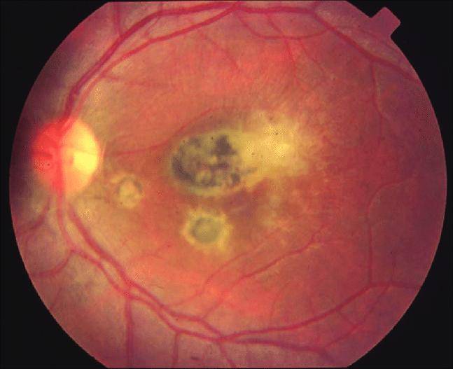 Хориоретинит глаза (хориоидит, задний увеит): что это такое, симптомы, лечение, виды (центральный, серозный, токсоплазмозный, пигментный) и прочее
