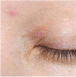 Причины сухости кожи вокруг глаз и лечение